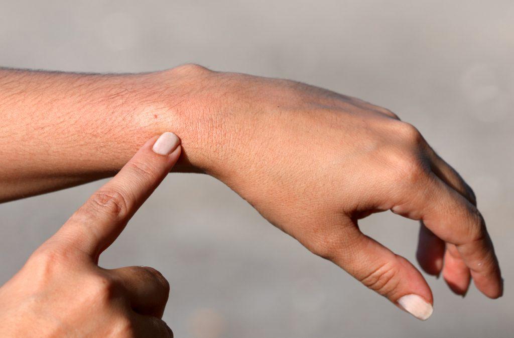 What does a wasp sting look like?
